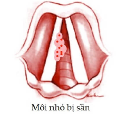 Môi nhỏ bị sần sùi